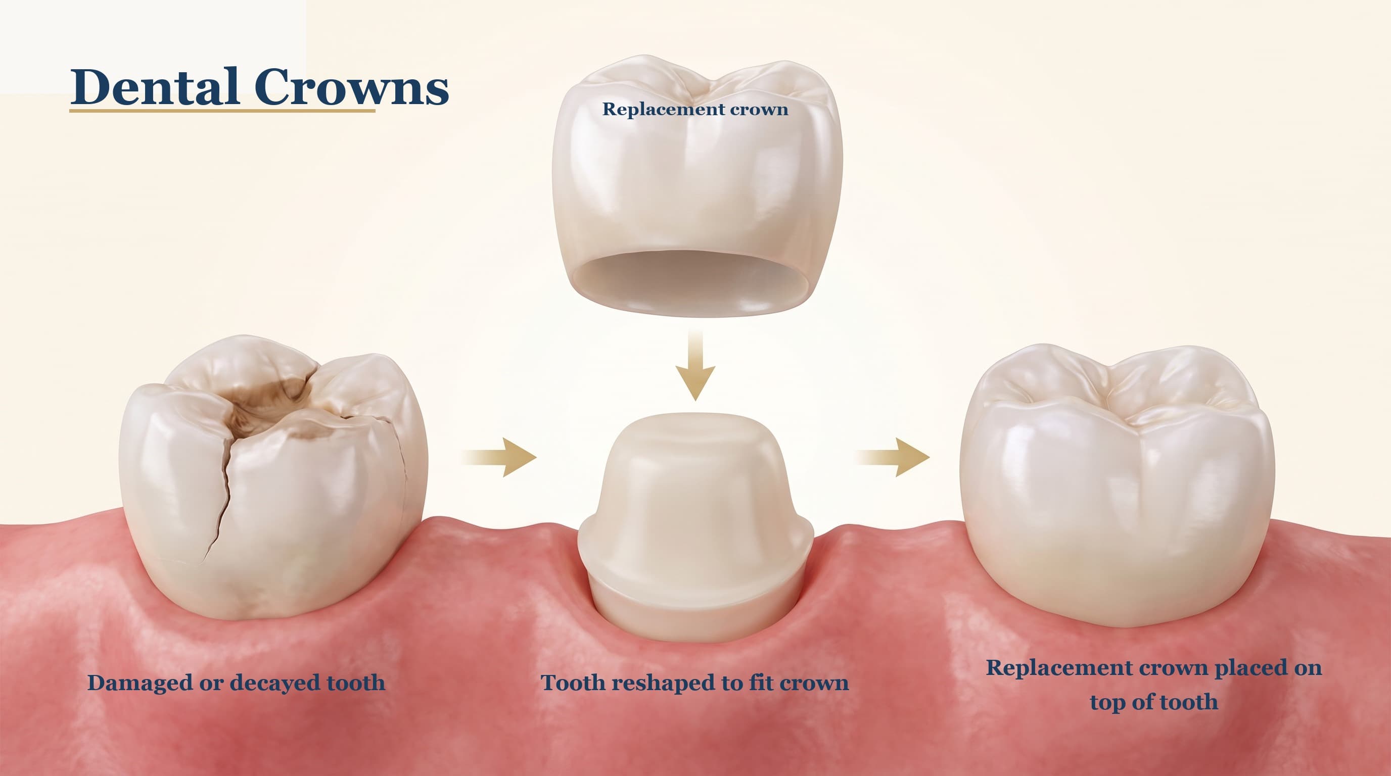 Dental Crowns in Torrance, CA: Restore Strength and Beauty